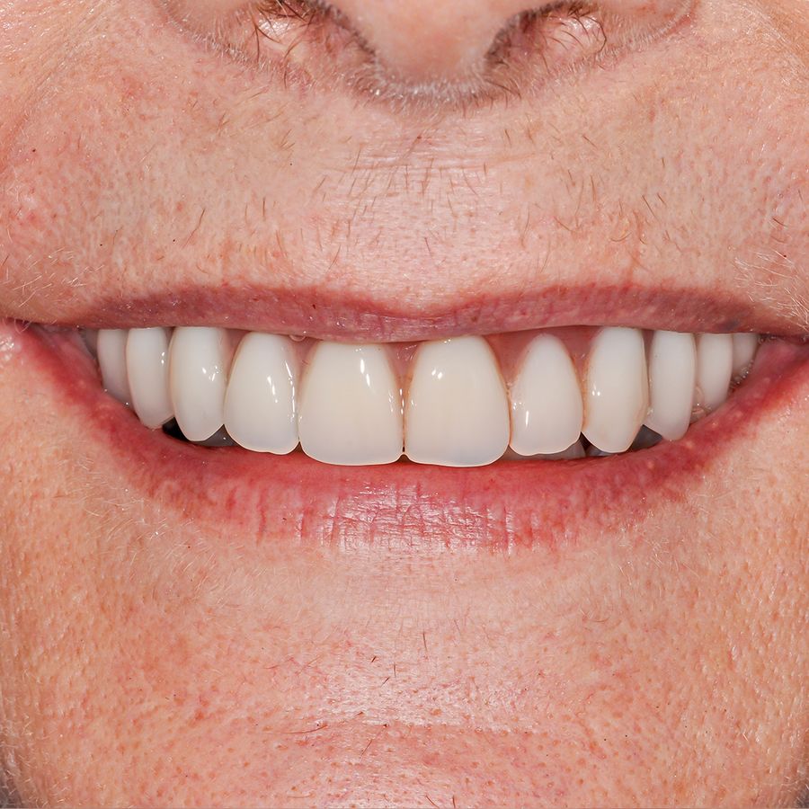 smile in a day - after - smile 26